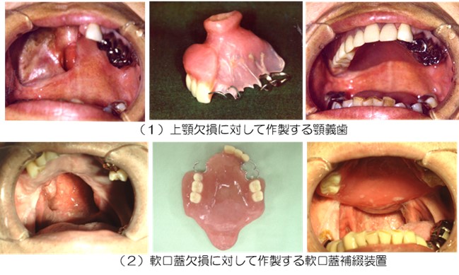 顎補綴の作製例